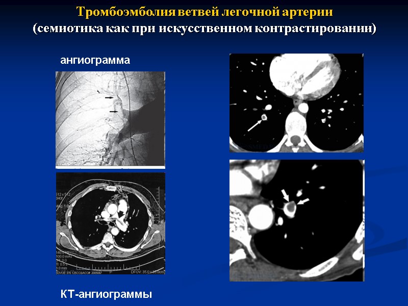 Тромбоэмболия ветвей легочной артерии (семиотика как при искусственном контрастировании) ангиограмма КТ-ангиограммы